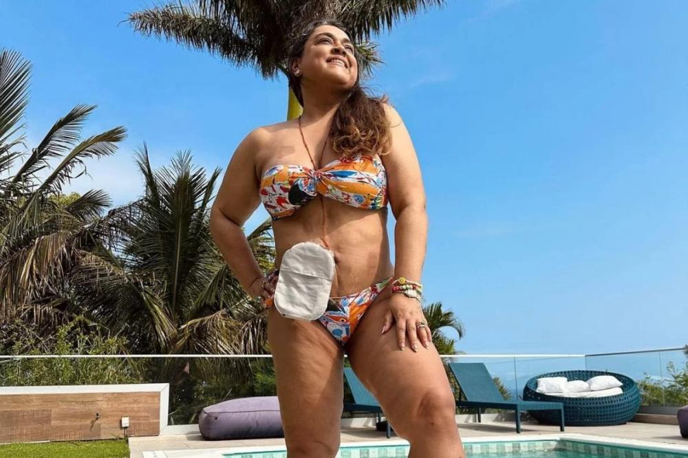 Ostomia: confira dicas para o manuseio correto do procedimento que salvou a vida da cantora Preta Gil
